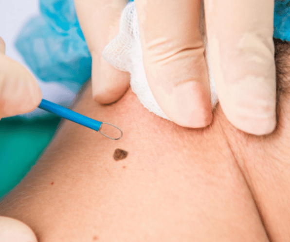 Mole & Wart Removal - Clear Smooth Skin